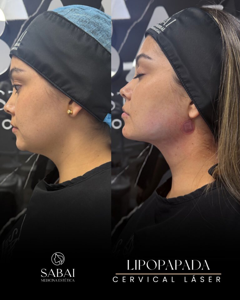 Procedimiento lipopapada