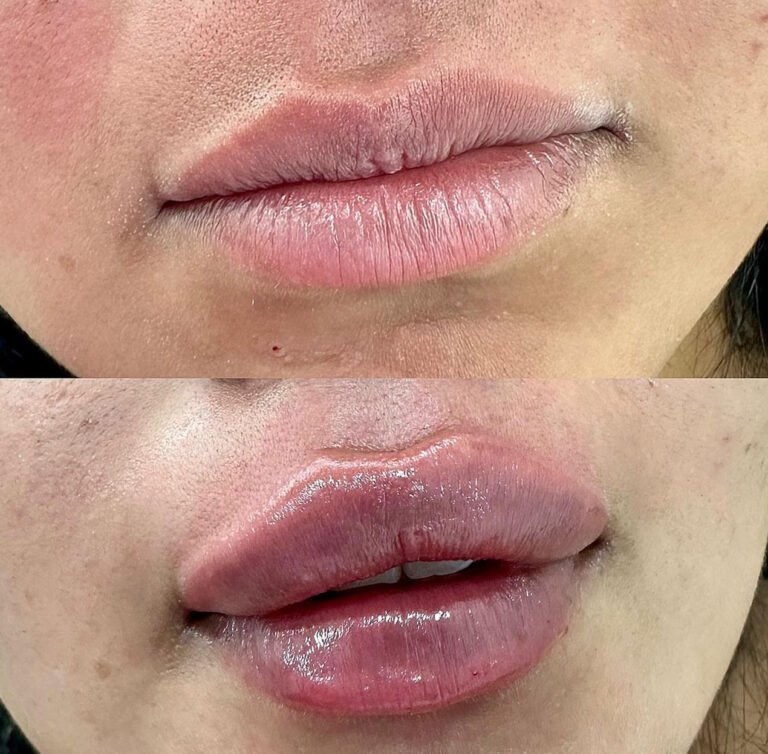 Aumento_de_labios
