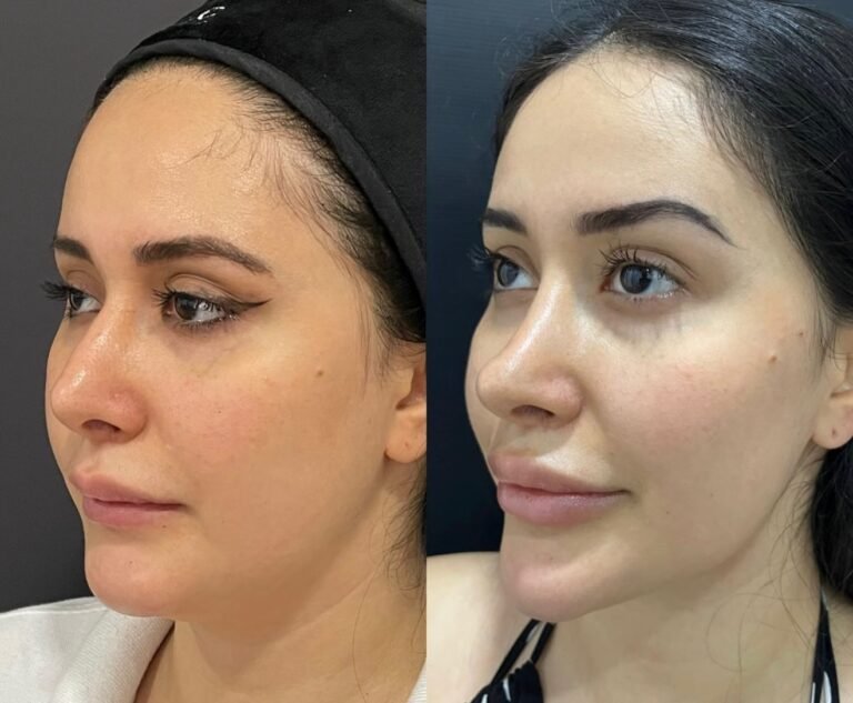 Endolift_laser_facial
