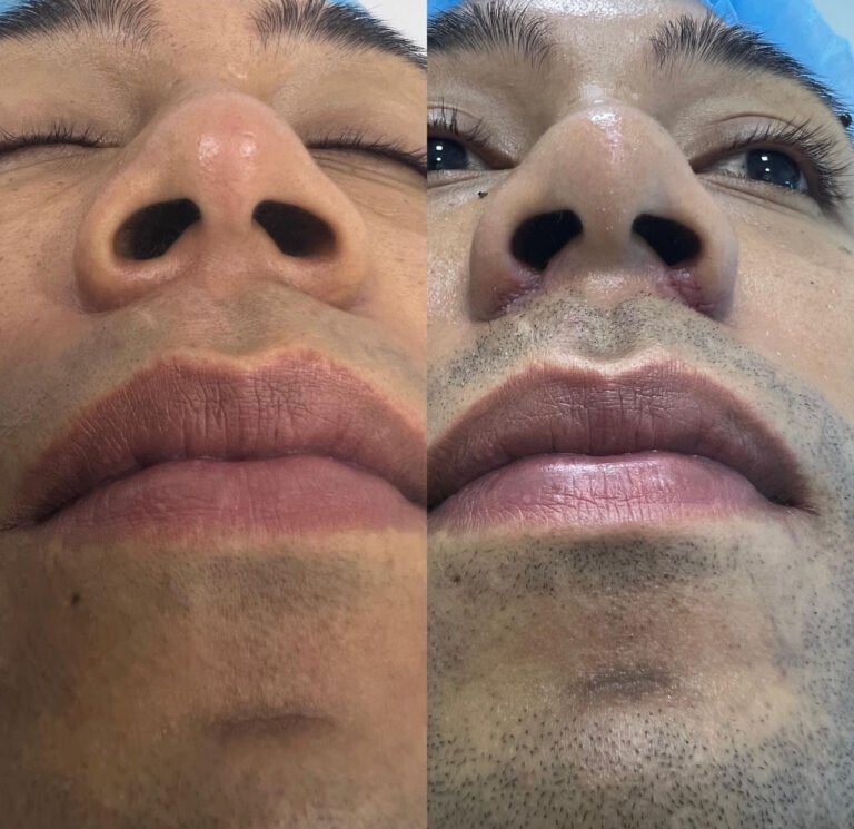 Alectomia_nasal