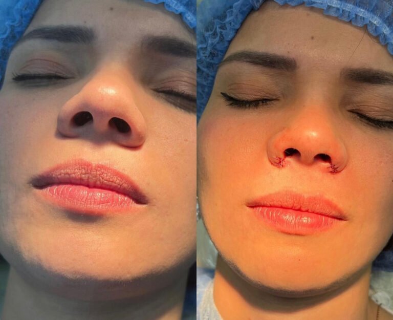 Alectomia_nasal