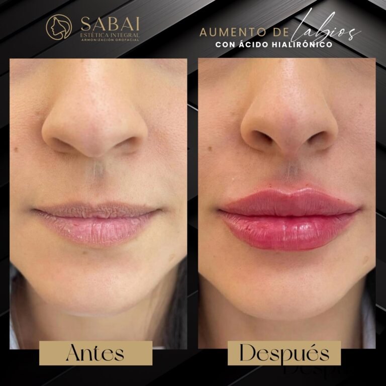 Aumento_de_labios