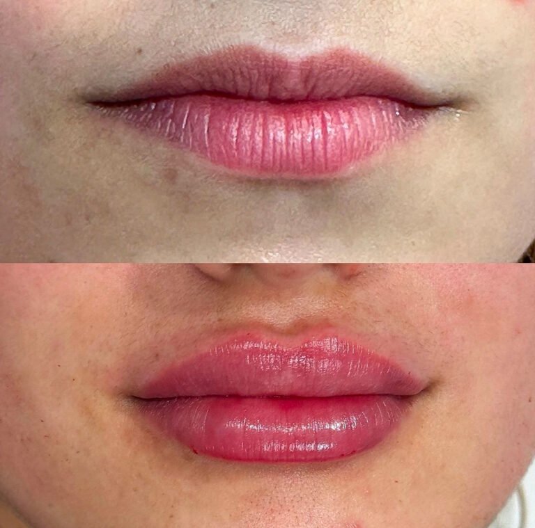 Aumento_de_labios