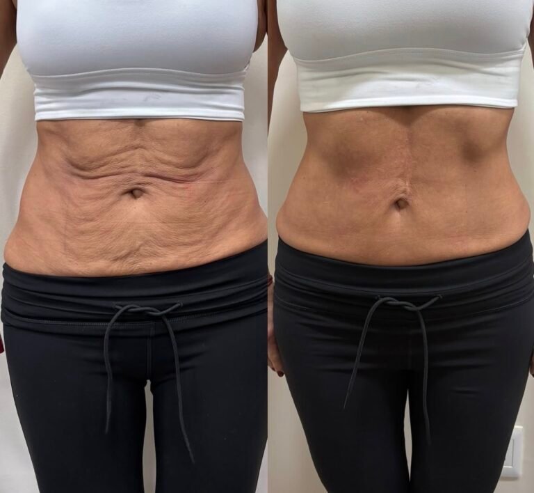Tratamiento endolift láser
