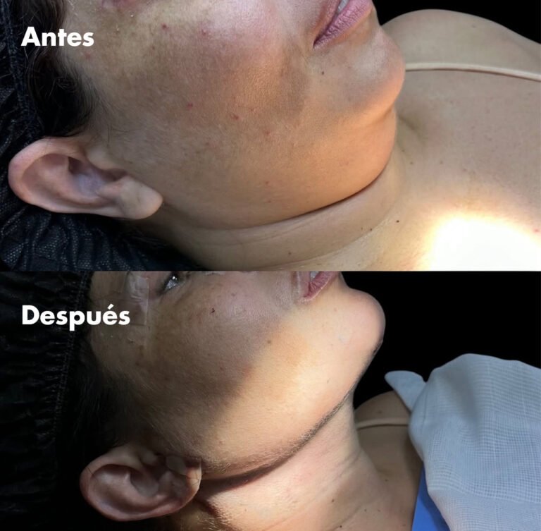 Procedimiento lipopapada