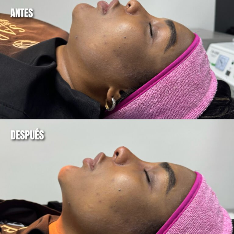 Lipopapada_procedimiento_estetico