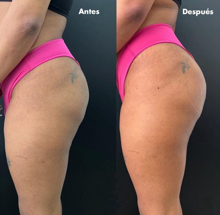 Sculptra_gluteos_antes_despues