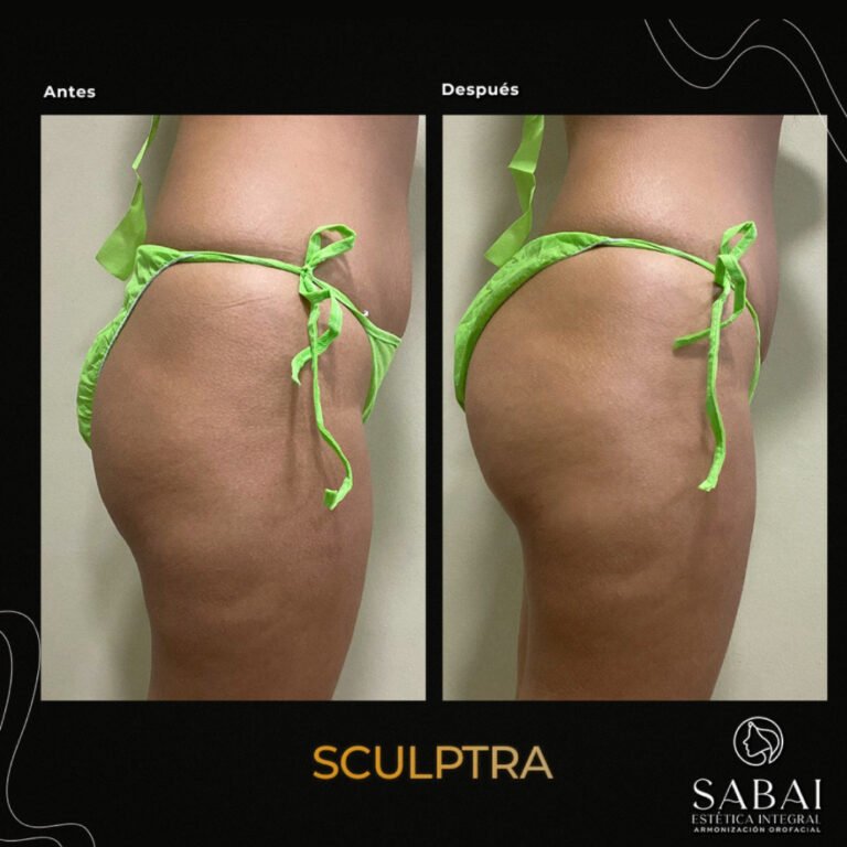 sculptra_gluteos