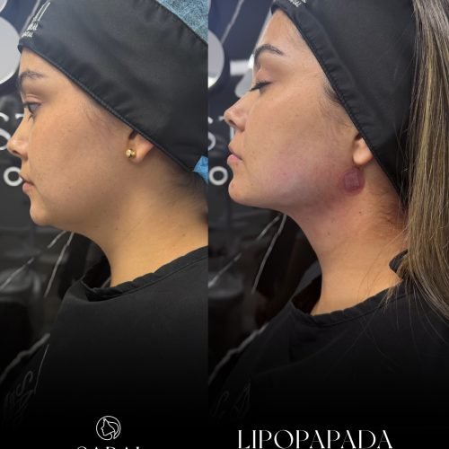 Procedimiento lipopapada