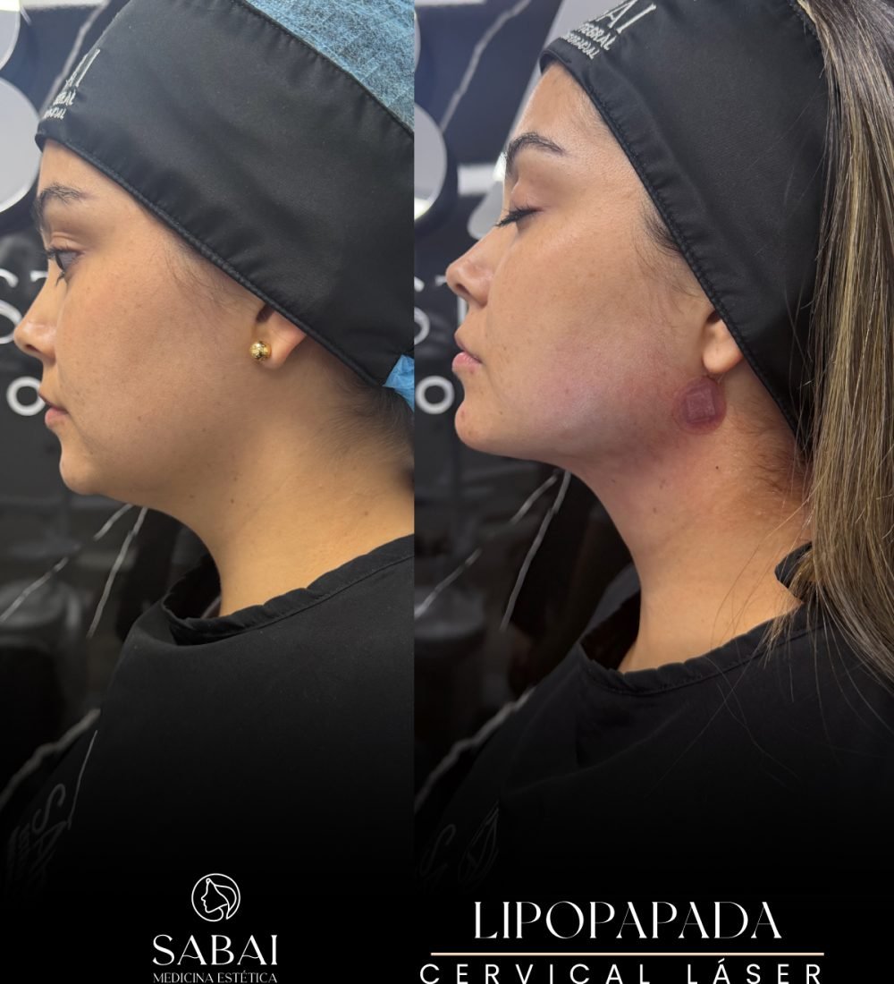 Procedimiento lipopapada