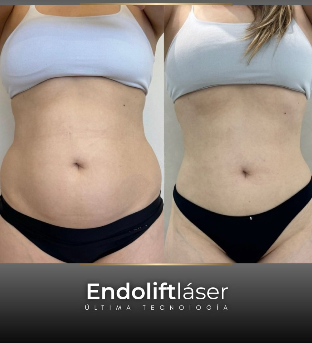 Endolift_laser