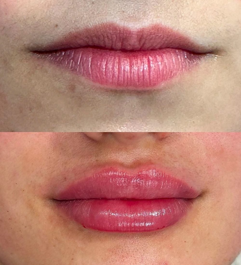 Aumento_de_labios