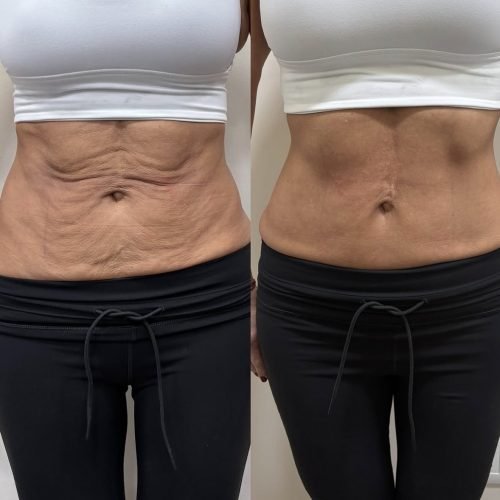 Tratamiento endolift láser