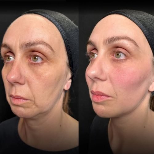 revujenecimiento facial